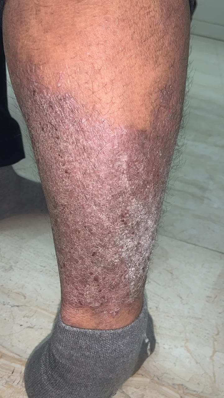 Understanding Psoriasis: End the Flare Cycle