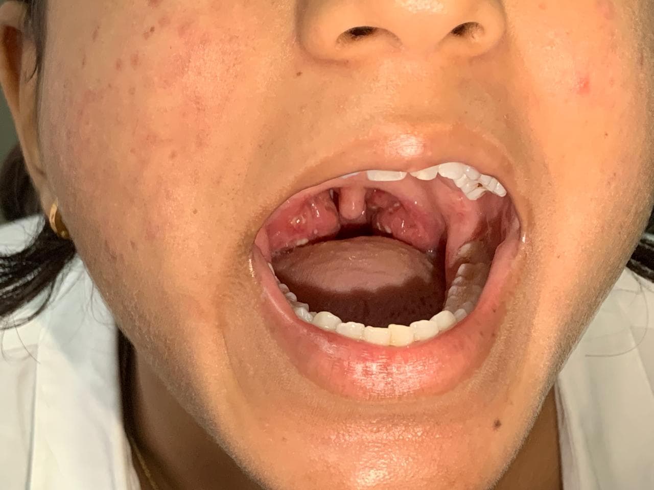 Understanding Tonsillitis: Avoid Surgery, Build Immunity
