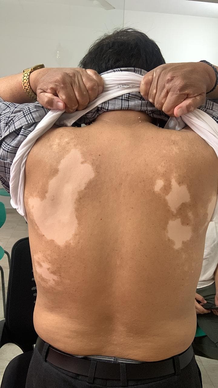 Understanding Vitiligo: Restore Your Skin's Color