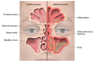 Understanding Sinusitis: Clear Sinuses, No Surgery