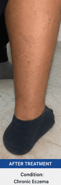 After treatment