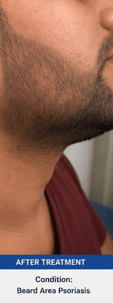 After treatment
