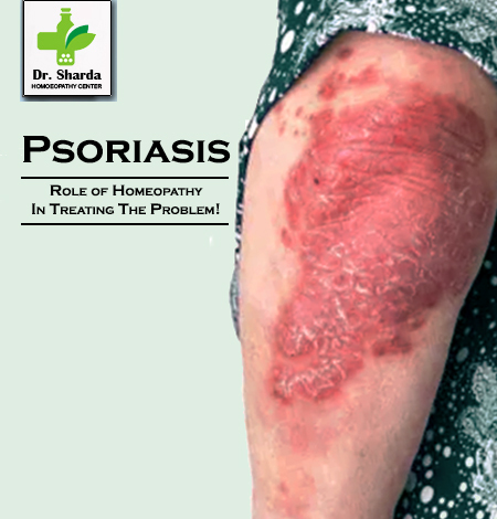 Psoriasis Homopathy Dr Sharda